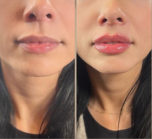 Before and After lips treatment results of a Woman | Just Glam Aesthetics in Astoria, New York