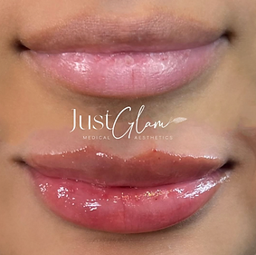 Before and After lips treatment results of a Woman | Just Glam Aesthetics in Astoria, New York