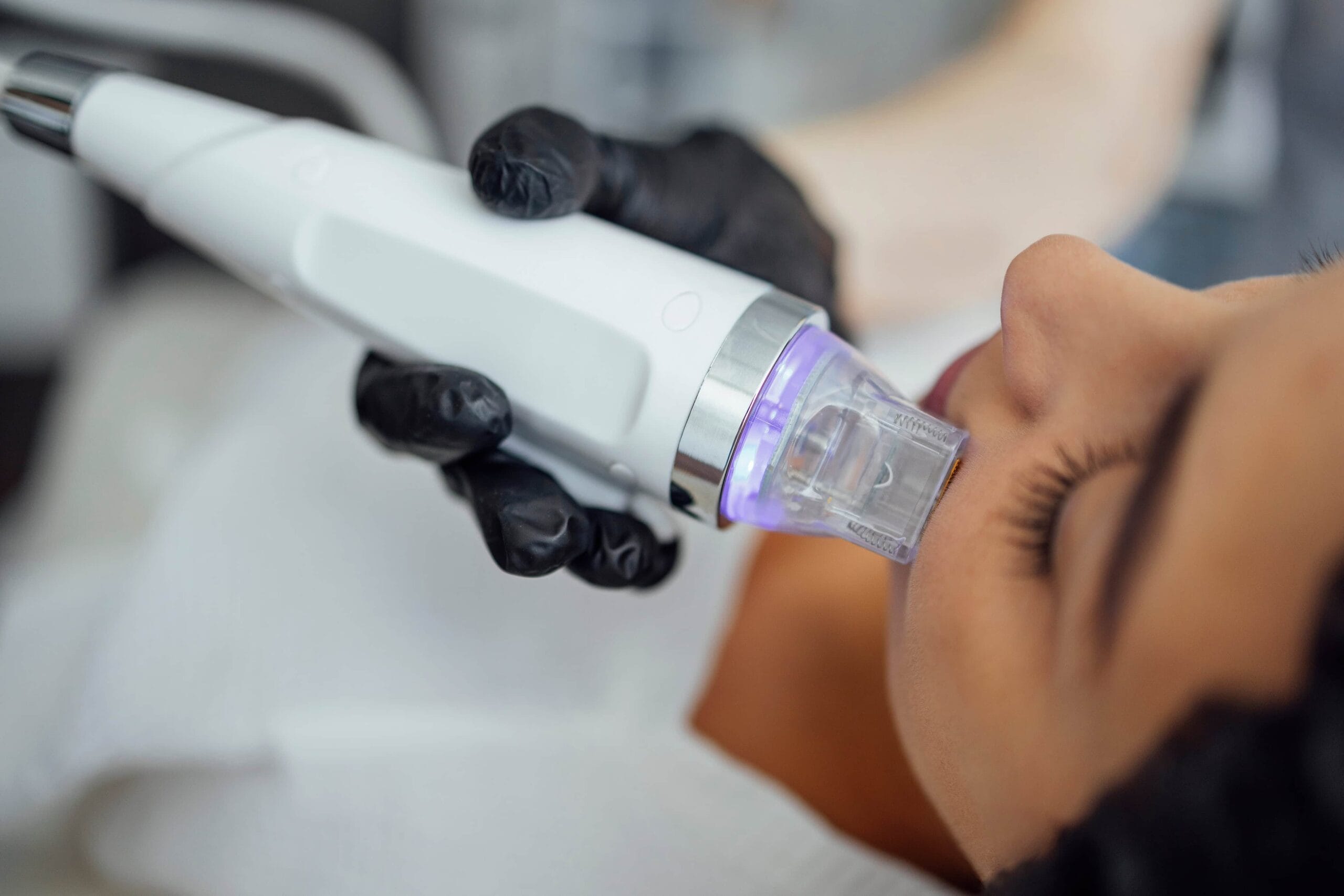 Microneedling by Just Glam Aesthetics in Astoria, New York